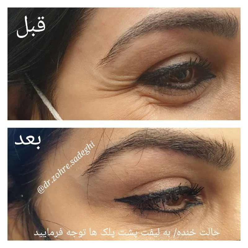 آموزش بوتاکس ویژه پزشکان