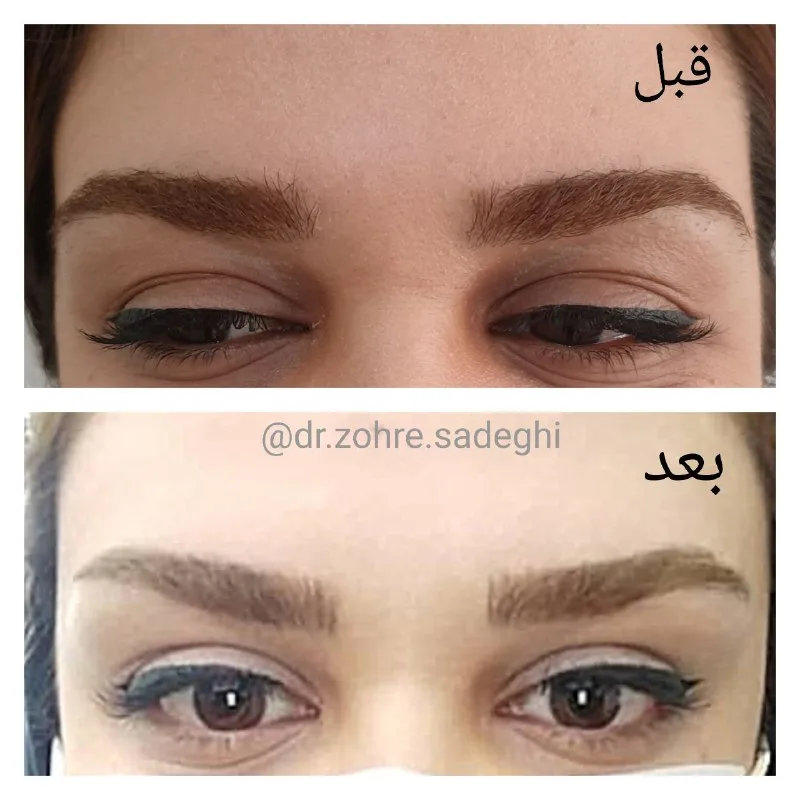 آموزش بوتاکس ویژه پزشکان